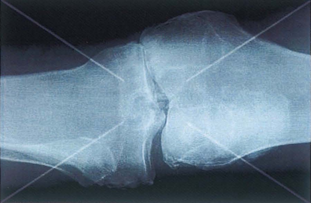 Röntgenbild: Männliches Knie